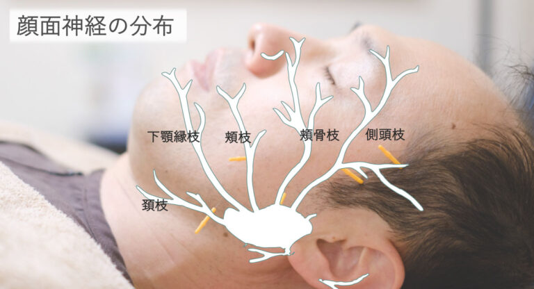 顔面神経麻痺の回復を！鏡フィードバックでの表情筋トレーニングのやり方