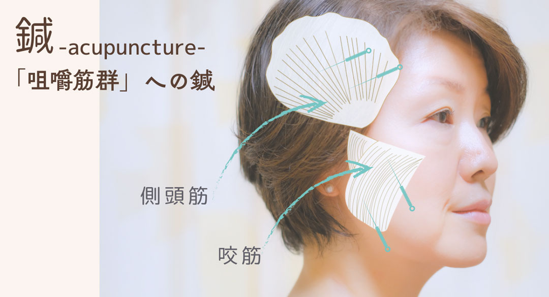 咀嚼筋群に鍼